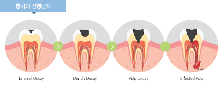 충치의 진행단계