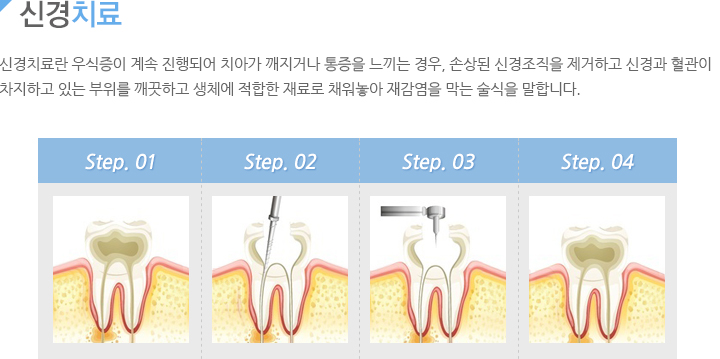 신경치료