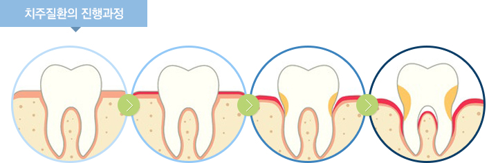 치주질환의 진행과정