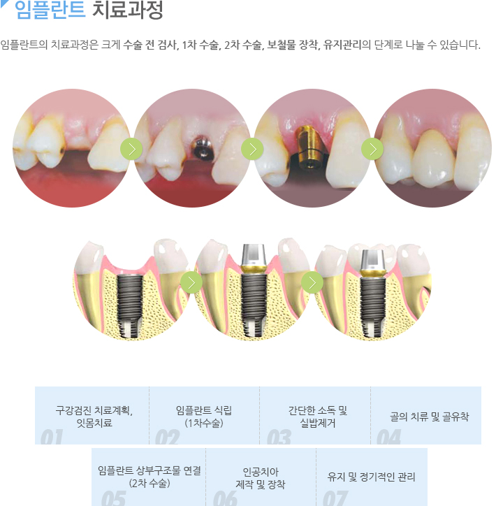 임플란트 치료과정