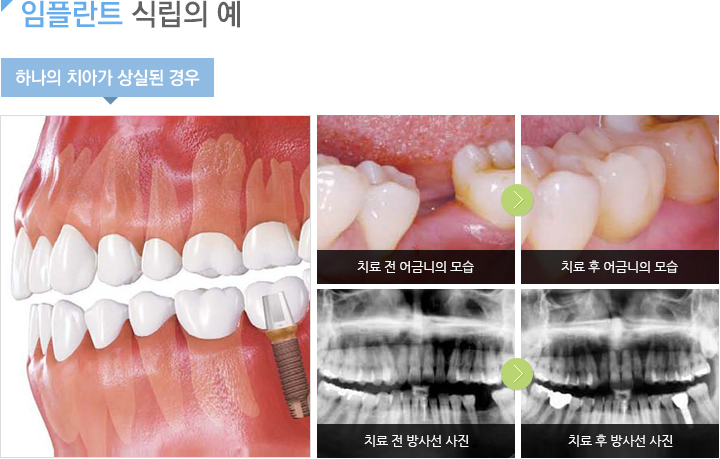 하나의 치아가 상실된 경우