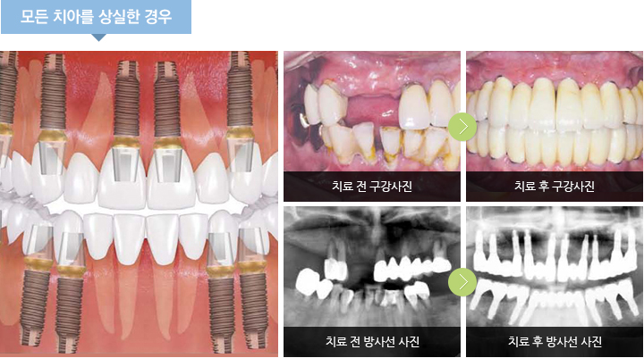 모든 치아를 상실한 경우