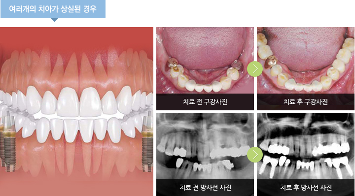 여러개의 치아가 상실된 경우