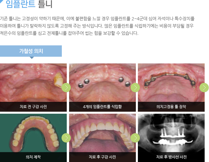 임플란트 틀니