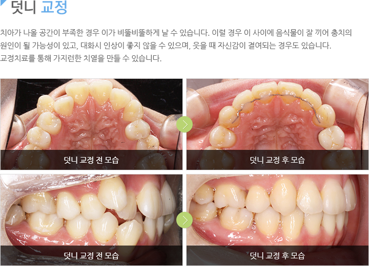 덧니교정