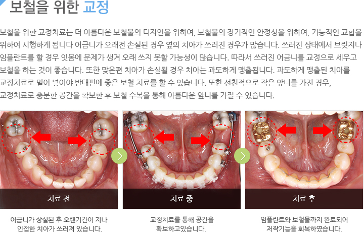 보철을 위한 교정